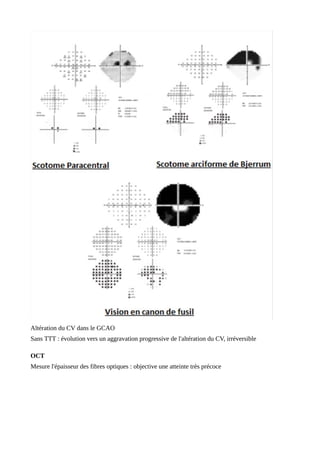 Altération du CV dans le GCAO
Sans TTT : évolution vers un aggravation progressive de l'altération du CV, irréversible
OCT
Mesure l'épaisseur des fibres optiques : objective une atteinte très précoce
 