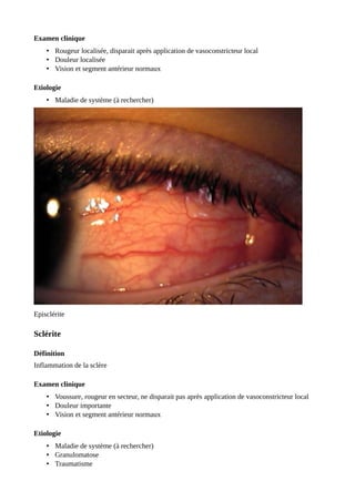 Examen clinique
• Rougeur localisée, disparait après application de vasoconstricteur local
• Douleur localisée
• Vision et segment antérieur normaux
Etiologie
• Maladie de système (à rechercher)
Episclérite
Sclérite
Définition
Inflammation de la sclère
Examen clinique
• Voussure, rougeur en secteur, ne disparait pas après application de vasoconstricteur local
• Douleur importante
• Vision et segment antérieur normaux
Etiologie
• Maladie de système (à rechercher)
• Granulomatose
• Traumatisme
 