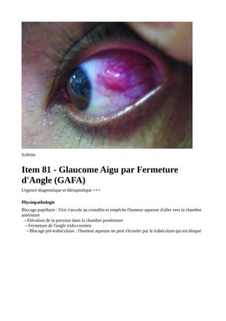 Sclérite
Item 81 - Glaucome Aigu par Fermeture
d'Angle (GAFA)
Urgence diagnostique et thérapeutique +++
Physiopathologie
Blocage pupillaire : l'iris s'accole au cristallin et empêche l'humeur aqueuse d'aller vers la chambre
antérieure
→Elévation de la pression dans la chambre postérieure
→Fermeture de l'angle irido-cornéen
→Blocage pré-trabéculaire : l'humeur aqueuse ne peut s'écouler par le trabéculum qui est bloqué
 