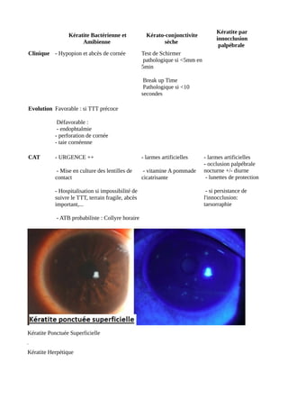 Kératite Bactérienne et
Amibienne
Kérato-conjonctivite
sèche
Kératite par
innocclusion
palpébrale
Clinique - Hypopion et abcès de cornée Test de Schirmer
pathologique si <5mm en
5min
Break up Time
Pathologique si <10
secondes
Evolution Favorable : si TTT précoce
Défavorable :
- endophtalmie
- perforation de cornée
- taie cornéenne
CAT - URGENCE ++
- Mise en culture des lentilles de
contact
- Hospitalisation si impossibilité de
suivre le TTT, terrain fragile, abcès
important,...
- ATB probabiliste : Collyre horaire
- larmes artificielles
- vitamine A pommade
cicatrisante
- larmes artificielles
- occlusion palpébrale
nocturne +/- diurne
- lunettes de protection
- si persistance de
l'innocclusion:
tarsorraphie
Kératite Ponctuée Superficielle
Kératite Herpétique
 