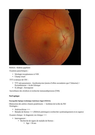 NOIAA - Œdème papillaire
Examens paracliniques :
• Sérologie toxoplasmose et VIH
• Champ visuel
TTT si menace de l'AV :
• TTT anti-parasitaires : Azythromycine (moins d’effets secondaires que l’Adiazine) +
Pyriméthamine + Acide folinique
• Si allergie : Atovaquone
Surveillance des récidives et recherche immunodépression (VIH)
Nerf optique
Neuropathie Optique Ischémique Antérieure Aiguë (NOIAA)
Obstruction des artères ciliaires postérieures → Ischémie de la tête du NO
Etiologies :
• Artériosclérose +++
• Maladie de Horton +++ (NOIAA artéritique) à rechercher systématiquemrnt et en urgence
Examen clinique : le diagnostic est clinique +++
• Interrogatoire :
• Recherche de signes de maladie de Horton :
• Age > 50 ans
 