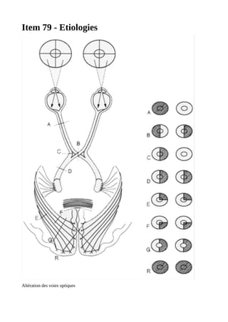 Item 79 - Etiologies
Altération des voies optiques
 