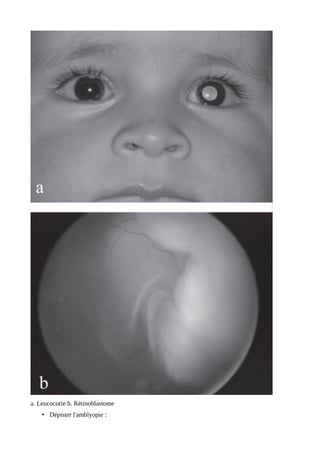 a. Leucocorie b. Rétinoblastome
• Dépister l'amblyopie :
 