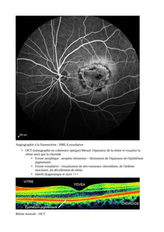 Angiographie à la fluorescéine : DMLA exsudative
• OCT (tomographie en cohérence optique) Mesure l'épaisseur de la rétine et visualise la
rétine ainsi que la choroïde
• Forme atrophique : atrophie rétinienne = diminution de l'épaisseur de l'épithélium
pigmentaire
• Forme exsudative : visualisation de néo-vaisseaux choroïdiens, de l'œdème
maculaire, du décollement de rétine
• Intérêt diagnostique et suivi +++
Rétine normale - OCT
 