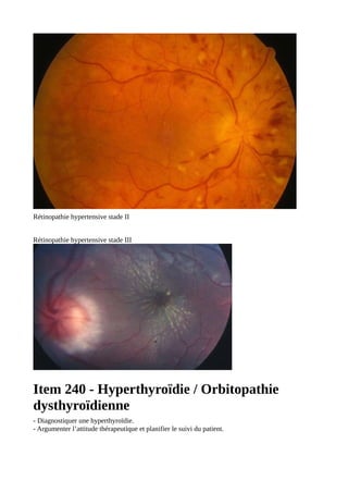 Rétinopathie hypertensive stade II
Rétinopathie hypertensive stade III
Item 240 - Hyperthyroïdie / Orbitopathie
dysthyroïdienne
- Diagnostiquer une hyperthyroïdie.
- Argumenter l’attitude thérapeutique et planifier le suivi du patient.
 