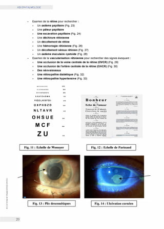 0
CJ
w
a:
CJ
w
a:
[l]
0
N
<(
z
a:
w
>
Cf)
z
0
0
w
@)
iKB OPHTALMOLOGIE
20
Examen de la rétine pour rechercher :
x Un œdème papillaire (Fig. 23)
x Une pâleur papillaire
x Une excavation papillaire (Fig. 24)
x Une déchirure rétinienne
x Un décollement de rétine
x Une hémorragie rétinienne (Fig. 26)
x Un décollement séreux rétinien (Fig. 27)
x Un œdème maculaire cystoïde (Fig. 28)
Examen de la vascularisation rétinienne pour rechercher des signes évoquant
x Une occlusion de la veine centrale de la rétine (OVCR) (Fig. 29)
x Une occlusion de l'artère centrale de la rétine (OACR) (Fig. 30)
x Des néovaisseaux
x Une rétinopathie diabétique (Fig. 32)
x Une rétinopathie hypertensive (Fig. 33)
MIITYPUINCllOlO ,...,o
0LYAT■MUEltSN thO
RCYMOFMl!SPA 1110
EXATZHOWN 7110
YOELKSFDI 1110
OXPHBZD !1110
NLTAVR <110
OHSUE 3110
M C F 2110
z u 1110
Fig. 11 : Echelle de Monoyer
Fig. 13 : Plis descemétiques
Bonheur
Echo de l'amour
Trouvez-le d•abord,
huchez-le ■P!_�
·--
U•H 1� ja,41■ • la fA■f.91'-«'
•�• •rtttt M dte.ti.'.M à tiouJ.
ftr IH 1•ll'N ·• liO" Oftll.iff 1�
P•"•''" •'•cco..•••••• d't1,.,
tf•a41!ul,al'.Wl'II lll'ttl•h, 11'
lt
.... a'a111bhi••-�·�•
IH ••••..•- al' •N••••h•I •al•I
....._...........-..-.......1. -�
........................._....�.._..__ ..
-........_,,......,........
_____,.,.,..___...._
.......__.....,................
._.__...,.._��
----------·-----..
-·-- �-:.::..:.=-��
Fig. 12 : Echelle de Parinaud
Fig. 14 : Ulcération cornéen
 