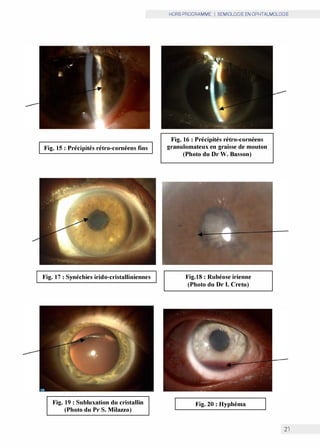 Fig. 15 : Précipités rétro-cornéens fins
Fig. 17 : Synéchies irido-cristalliniennes
Fig. 19 : Subluxation du cristallin
(Photo du Pr S. Milazzo)
HORS PROGRAMME I SEMIOLOGIE EN OPHTALMOLOGIE
Fig. 16 : Précipités rétro-cornéens
granulomateux en graisse de mouton
(Photo du Dr W. Basson)
Fig.18 : Rubéose irienne
(Photo du Dr I. Cretu)
Fig. 20 : Hyphéma
21
 
