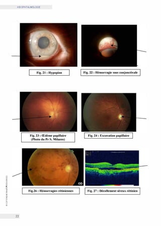 0
(.'.)
w
0:
(.'.)
Cl)
w
0:
CO
0
N
<t
z
0:
w
>
Cl)
z
0
t:
0
w
@
iKB OPHTALMOLOGIE
22
Fig. 21: Hypopion
Fig. 23: Œdème papillaire
(Photo du Pr S. Milazzo)
Fig.26: Hémorragies rétiniennes
Fig. 22: Hémorragie sous conjonctivale
Fig. 24: Excavation papillaire
Fig. 27: Décollement séreux rétinien
 