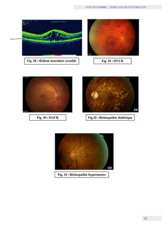 HORS PROGRAMME I SEMIOLOGIE EN OPHTALMOLOGIE
Fig. 28 : Œdème maculaire cystoïde Fig. 29 : OVCR
Fig. 30 : OACR Fig.32 : Rétinopathie diabétique
Fig. 33 : Rétinopathie hypertensive
23
 