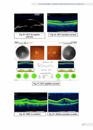 HORS PROGRAMME I EXAMENS COMPLEMENTAIRES EN OPHTALMOLOGIE
Fig. 35: OCT du segment
antérieur
Fig. 36: OCT maculaire normal
OD(R)! 1mogoQueldy 46 modo F",nc,(2oO) modo F",no(2O0)lmo<)O°'""'Y 44 1 OS(l)1
Cep(Ke 0.IO 18I00/2015
Il"
2CO
100
0
�a·
C.p<ure O.,., 18/06!2015
Red.frH
103
R.NFL Thleknen = �:
=�
OT S N I T
RNFLS� 90%
Average thlcknen RNFL.(µm)
91 T.,.I Thclmo»
123 Su-
103 lnfonor
92
116
104
Il"
2CO
100
1()4
s Jlturt·
Fig. 37: OCT papillaire normal
RHl-trea
oa:e
Fig. 38: DMLA exsudative Fig. 39: Œdème maculaire cystoïde
27
 