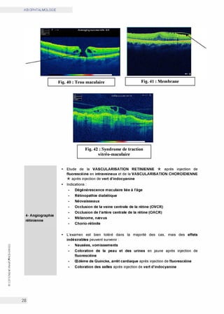 0
(.'.)
w
0:
(.'.)
w
0:
CO
0
N
<t
z
0:
w
>
Cl)
z
0
t:
0
w
@
iKB OPHTALMOLOGIE
4- Angiographie
rétinienne
28
Fig. 40: Trou maculaire Fig. 41: Membrane
Fig. 42: Syndrome de traction
vitréo-maculaire
• Etude de la VASCULARISATION RETINIENNE * après injection de
fluorescéine en intraveineux et de la VASCULARISATION CHOROÏDIENNE
*après injection de vert d'indocyanine
• Indications :
Dégénérescence maculaire liée à l'âge
Rétinopathie diabétique
Néovaisseaux
Occlusion de la veine centrale de la rétine (OVCR)
Occlusion de l'artère centrale de la rétine (OACR)
Mélanome, nœvus
Chorio-rétinite
• L'examen est bien toléré dans la majorité des cas, mais des effets
indésirables peuvent survenir :
Nausées, vomissements
Coloration de la peau et des urines en jaune après injection de
fluorescéïne
Œdème de Quincke, arrêt cardiaque après injection de fluorescéïne
Coloration des selles après injection de vert d'indocyanine
 