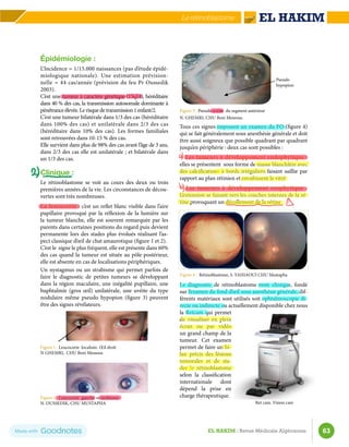 63
EL HAKIM : Revue Médicale Algérienne
Le rétinoblastome
Épidémiologie :
L’Incidence ≈ 1/15.000 naissances (pas d’étude épidé-
miologique nationale). Une estimation prévision-
nelle ≈ 44 cas/année (prévision du feu Pr Oussedik
2003).
C’est une tumeur à caractère génétique (13q14), héréditaire
dans 40 % des cas, la transmission autosomale dominante à
pénétranceélevée.Lerisquedetransmission1enfant/2.
C’est une tumeur bilatérale dans 1/3 des cas (héréditaire
dans 100% des cas) et unilatérale dans 2/3 des cas
(héréditaire dans 10% des cas). Les formes familiales
sont retrouvées dans 10-15 % des cas.
Elle survient dans plus de 98% des cas avant l’âge de 3 ans,
dans 2/3 des cas elle est unilatérale ; et bilatérale dans
un 1/3 des cas.
Clinique :
Le rétinoblastome se voit au cours des deux ou trois
premières années de la vie. Les circonstances de décou-
vertes sont très nombreuses.
La leucocorie : c’est un reflet blanc visible dans l’aire
pupillaire provoqué par la réflexion de la lumière sur
la tumeur blanche, elle est souvent remarquée par les
parents dans certaines positions du regard puis devient
permanente lors des stades plus évolués réalisant l’as-
pect classique d’œil de chat amaurotique (figure 1 et 2).
C’est le signe le plus fréquent, elle est présente dans 60%
des cas quand la tumeur est située au pôle postérieur,
elle est absente en cas de localisations périphériques.
Un nystagmus ou un strabisme qui permet parfois de
faire le diagnostic de petites tumeurs se développant
dans la région maculaire, une inégalité pupillaire, une
buphtalmie (gros œil) unilatérale, une uvéite du type
nodulaire même pseudo hypopion (figure 3) peuvent
être des signes révélateurs.
Figure 1 : Leucocorie localisée. Œil droit
N Ghemri, CHU Beni Messous
Figure 2 : Leucocorie gauche et strabisme
N. Oussedik, CHU MUSTAPHA
Figure 3 : Pseudo uvéite du segment antérieur
N. Ghemri, CHU Beni Messous.
Tous ces signes imposent un examen du FO (figure 4)
qui se fait généralement sous anesthésie générale et doit
être aussi soigneux que possible quadrant par quadrant
jusqu’en périphérie : deux cas sont possibles :
− Les tumeurs à développement endophytique :
elles se présentent sous forme de masse blanchâtre avec
des calcifications à bords irréguliers faisant saillie par
rapport au plan rétinien et envahissent le vitré
− Les tumeurs à développement exophytique :
L’extension se faisant vers les couches internes de la ré-
tine provoquant un décollement de la rétine
Figure 4 : Rétinoblastome, S. Yahiaoui CHU Mustapha
Le diagnostic de rétinoblastome reste clinique, fondé
sur l’examen du fond d’œil sous anesthésie générale, dif-
férents matériaux sont utilisés soit ophtalmoscopie di-
recte ou indirecte ou actuellement disponible chez nous
la Retcam qui permet
de visualiser en plein
écran ou par vidéo
un grand champ de la
tumeur. Cet examen
permet de faire un bi-
lan précis des lésions
tumorales et de sta-
der le rétinoblastome
selon la classification
internationale dont
dépend la prise en
charge thérapeutique.
	
   Pseudo
hypopion
	
  
Ret cam. Vision care
 