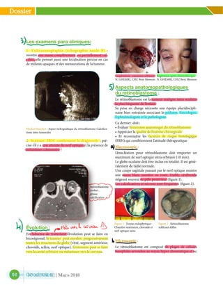 64
Dossier
N° 10 | Vol. III | Mars 2018
Les examens para cliniques:
1- L’ultrasonographie (échographie mode B) :
montre une masse complètement ou partiellement cal-
cifiée, elle permet aussi une localisation précise en cas
de milieux opaques et des mensurations de la tumeur.
Flèches blanches : Aspect échograhique du rétinoblastome Calcifica-
tions intra tumorales
2- Scanner IRM confirment le diagnostic ; pré-
cise s’il y a une atteinte du nerf optique et la présence de
métastases crâniennes.
Évolution :
En l’absence de traitement l’évolution peut se faire en
locorégional, la tumeur peut envahir progressivement
toutes les structures du globe (vitré, segment antérieur,
choroïde, sclère, nerf optique). L’extension peut se faire
vers la cavité orbitaire ou métastaser vers le cerveau.
Aspects anatomopathologiques
du retinoblastome
Le rétinoblastome est la tumeur maligne intra oculaire
la plus fréquente de l’enfant.
Sa prise en charge nécessite une équipe pluridiscipli-
naire bien entrainée associant le pédiatre, l’oncologue,
l’ophtalmologiste et le pathologiste.
Ce dernier doit :
• Évaluer l’extension anatomique du rétinoblastome
• Apprécier la qualité de l’exérèse chirurgicale
• Et reconnaitre les facteurs de risque histologique
(FRH) qui conditionnent l’attitude thérapeutique
Macroscopie :
L’énucléation pour rétinoblastome doit emporter un
maximum de nerf optique intra orbitaire (10 mm).
Le globe oculaire doit être inclus en totalité. Il est géné-
ralement de taille normale.
Une coupe sagittale passant par le nerf optique montre
une masse blanc-jaunâtre ou rosée, friable, cérébroïde
siégeant souvent au pôle postérieur (figure 1).
Les calcifications et nécrose sont fréquentes (figure 2).
Microscopie :
Le rétinoblastome est composé de plages de cellules
basophiles arrondies au noyau hyper chromatique et au
	
  
Rétinoblastome
évolué :
grosse
calcification
Exophtalmie : extension orbitaire
N. Ghemri, CHU Beni Messous
Régression après chimiothérapie
N. Ghemri, CHU Beni Messous
Figure 1 : Forme endophytique :
Chambre antérieure, choroïde et
nerf optique sains
Figure 2 : Rétinoblastome
infiltrant diffus
	
  
	
  
 