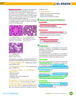 65
EL HAKIM : Revue Médicale Algérienne
Le rétinoblastome
cytoplasme peu abondant. Les mitoses sont nombreuses.
Des foyers de nécrose et de calcifications sont notés.
On observe des rosettes de Homer-Wright avec un en-
chevêtrement de neurofibrilles au centre (figure 3) et
des rosettes de Flexner-Wintersteiner à lumière centrale
(figure 4), ou des fleurettes en faveur d’une différencia-
tion de type photorécepteur (figure 5).
La tumeur peut franchir la lame criblée du nerf optique
et s’étendre jusqu’à sa tranche de section qu’il faudra
examiner histologiquement.
En fonction des caractéristiques anatomiques de l’œil, les cri-
tèresd’étudeanatomopathologiquesretenussontlessuivants:
1. Mode de développement : endophytique, exophy-
tique, infiltrant diffus
2. Différenciation tumorale : bien, moyennement,
peu ou indifférencié
3. Extension en dehors vers les différentes tu-
niques de l’œil
− État de la choroïde
− État de la sclère
− Infiltration des muscles oculomoteurs
− Essaimage vitréen
4. Extension en avant en précisant l’état de la
chambre antérieure, de l’iris et des procès ciliaires
5. Degré d’envahissement du nerf optique sur un
plan de coupe sagittal : atteinte pré laminaire, lami-
naire, rétro laminaire, atteinte de la marge de résection
distale de ce nerf.
6. Autres éléments
− Étendue de la nécrose, de l’hémorragie,
− Présence de calcifications
− Présence ou non d’embols vasculaires
Facteurs de risque histologiques :
Risque élevé
- Envahissement de la tranche de section du nerf op-
tique et/ ou des gaines méningées
- Envahissement microscopique extra scléral
Risque moyen
- Envahissement rétro laminaire du nerf optique et/ou
envahissement choroïdien massif (+corps ciliaires et iris)
- Envahissement de la chambre antérieure
Risque faible
- Envahissement choroïdien minime
- Et/ ou envahissement pré laminaire
- Ou pas d’envahissement du nerf optique
Traitement :
La prise en charge est multidisciplinaire de nouvelles
disciplines sont incluses actuellement avec l’apparition
de nouvelles thérapeutiques.
Les traitements locaux
Les traitements locaux du rétinoblastome sont de plus en
plus performants. Ils peuvent être associés sur le même
œil en fonction de la taille et du siège de la tumeur.
Cryothérapie
Elle consiste à geler la tumeur à l’aide d’une cryode qui
descend jusqu’à -180 °C. Le traitement est réalisé sous
anesthésie générale et sous contrôle du fond d’œil.
La cryothérapie est efficace pour des tumeurs ne dépas-
sant pas 3 mm de diamètre et 2 mm d’épaisseur situées
en avant de l’équateur.
Photocoagulation
Elle permet de traiter des tumeurs ne dépassant pas
2 mm de diamètre, postérieures à l’équateur. On évite
soigneusement de photocoaguler directement la tumeur
pour ne pas provoquer un essaimage dans le vitré.
Curiethérapie
Les disques d’iode 125 permettent de traiter des tumeurs
périphériques (antérieures à l’équateur), ne dépassant
pas 15 mm de diamètre. Ils sont très efficaces en cas
d’envahissement localisé du vitré.
Figue 3 : Rétinoblastome :
rosettes de Homer - Wright avec
un enchevêtrement de neurofi-
brilles en leur centre. (HEX40)
Figue 5 : Rétinoblastome
agencement des cellules en
bouquet arciforme (HE x 40)
Figue 4 : Rétinoblastome :
rosettes de Flexner – Winters-
teiner petites, rondes à lumière
centrale (HE x 40)
 
