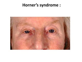 Horner’s syndrome :
 