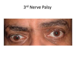 3rd Nerve Palsy
 