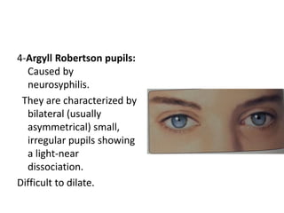 4-Argyll Robertson pupils:
Caused by
neurosyphilis.
They are characterized by
bilateral (usually
asymmetrical) small,
irregular pupils showing
a light-near
dissociation.
Difficult to dilate.
 