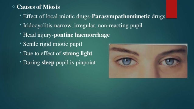 icd10 miotic pupil