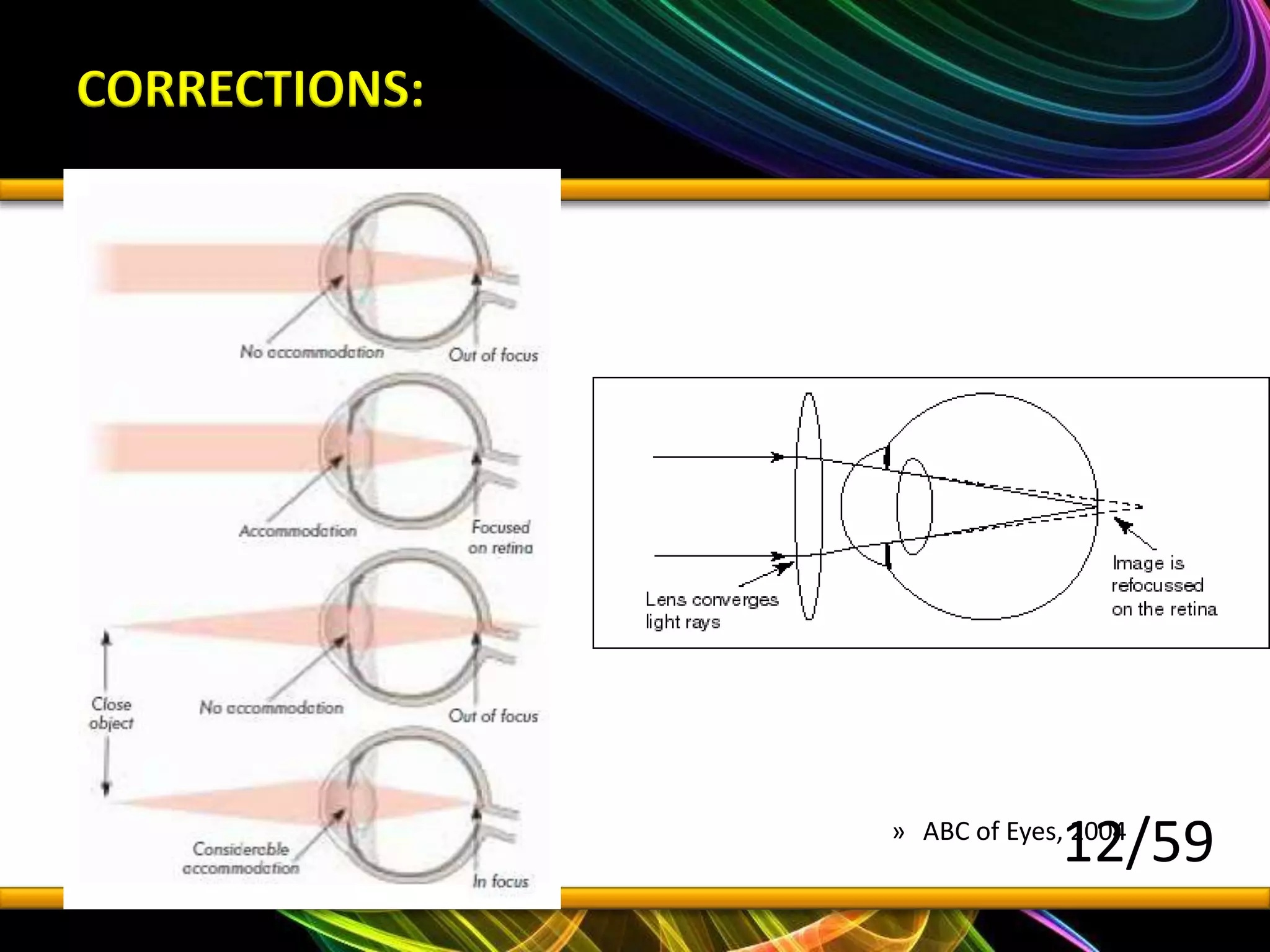 Ophthal refractive error and cataract | PPTX