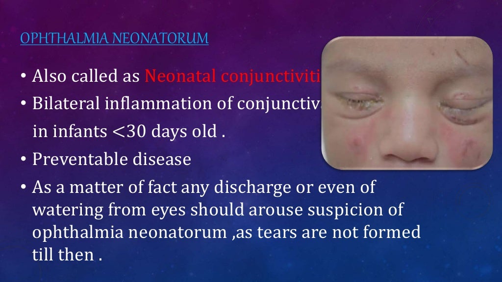 Ophthalmia Neonatorum/ Neonatal Conjunctivitis