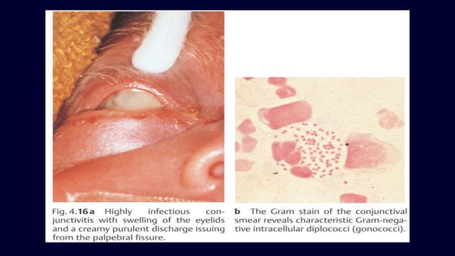 Ophthalmia neonatrum | PPTX