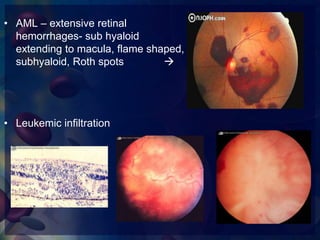 Ophthalmic Manifestations of Hematological Malignancies | PPTX