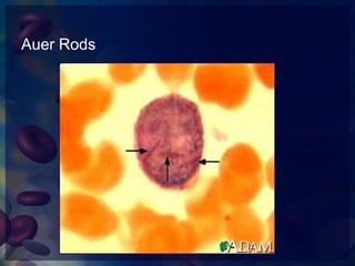Ophthalmic manifestations of leukemia | PPTX