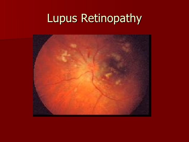 Lupus and Your Eyes