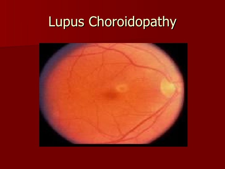 Lupus and Your Eyes