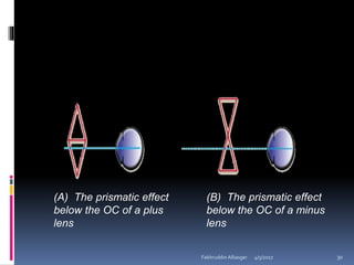 (A) The prismatic effect
below the OC of a plus
lens
(B) The prismatic effect
below the OC of a minus
lens
4/5/2017Fakhruddin Alliasger 30
 