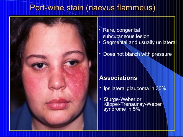 Image result for nevus flammeus eyelid
