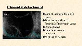 Vortex Detachment Ophthalmic Ultrasonography: How to Perform and Interpret | PPTX
