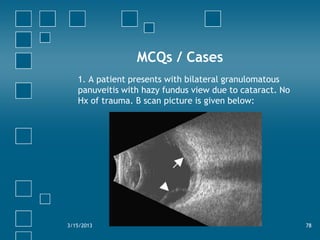 MCQs / Cases
   1. A patient presents with bilateral granulomatous
   panuveitis with hazy fundus view due to cataract. No...