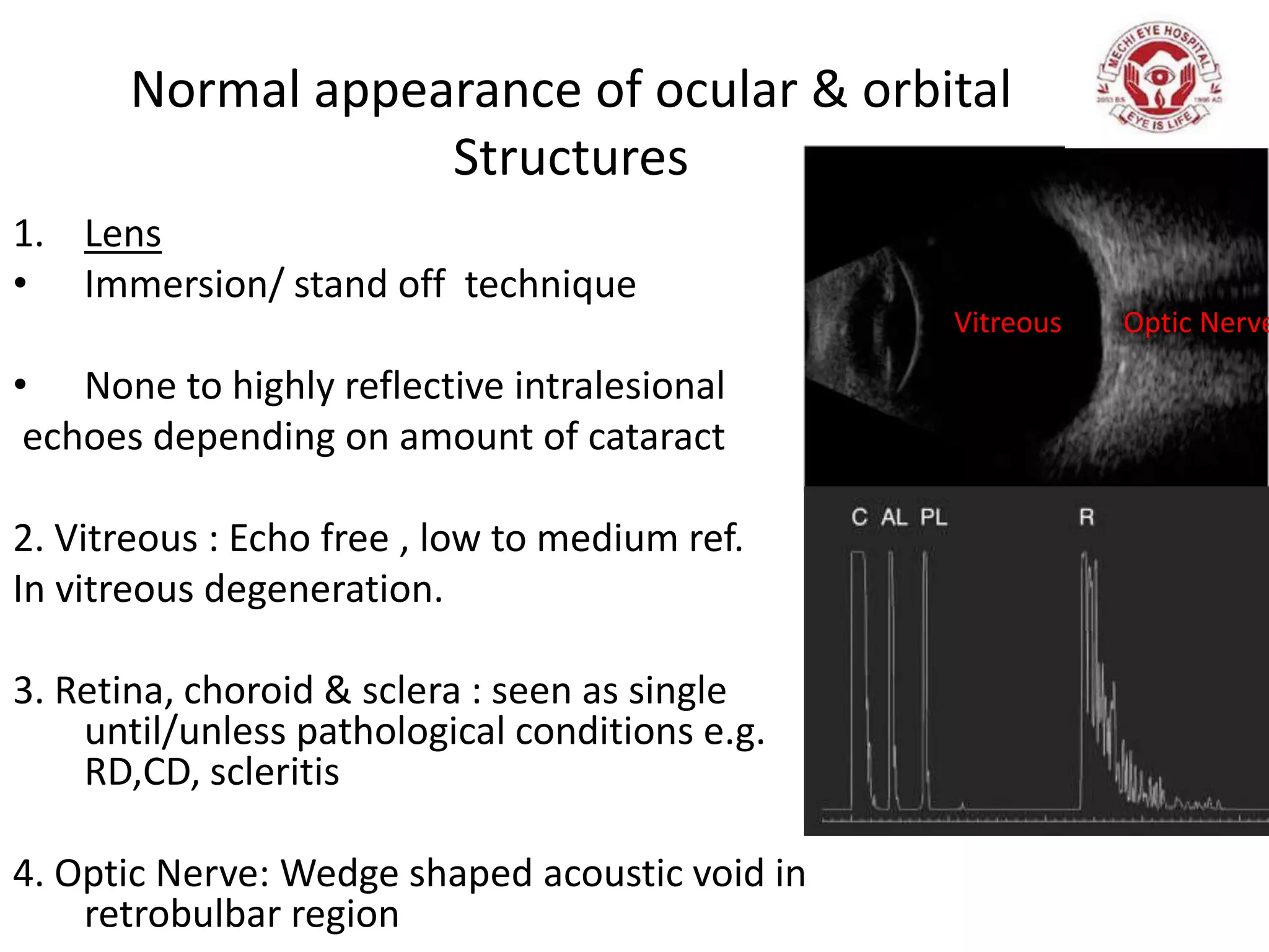 Normal appearance of ocular & orbital
Structures
1. Lens
• Immersion/ stand off technique
• None to highly reflective intralesional
echoes depending on amount of cataract
2. Vitreous : Echo free , low to medium ref.
In vitreous degeneration.
3. Retina, choroid & sclera : seen as single
until/unless pathological conditions e.g.
RD,CD, scleritis
4. Optic Nerve: Wedge shaped acoustic void in
retrobulbar region
Vitreous Optic Nerve
 