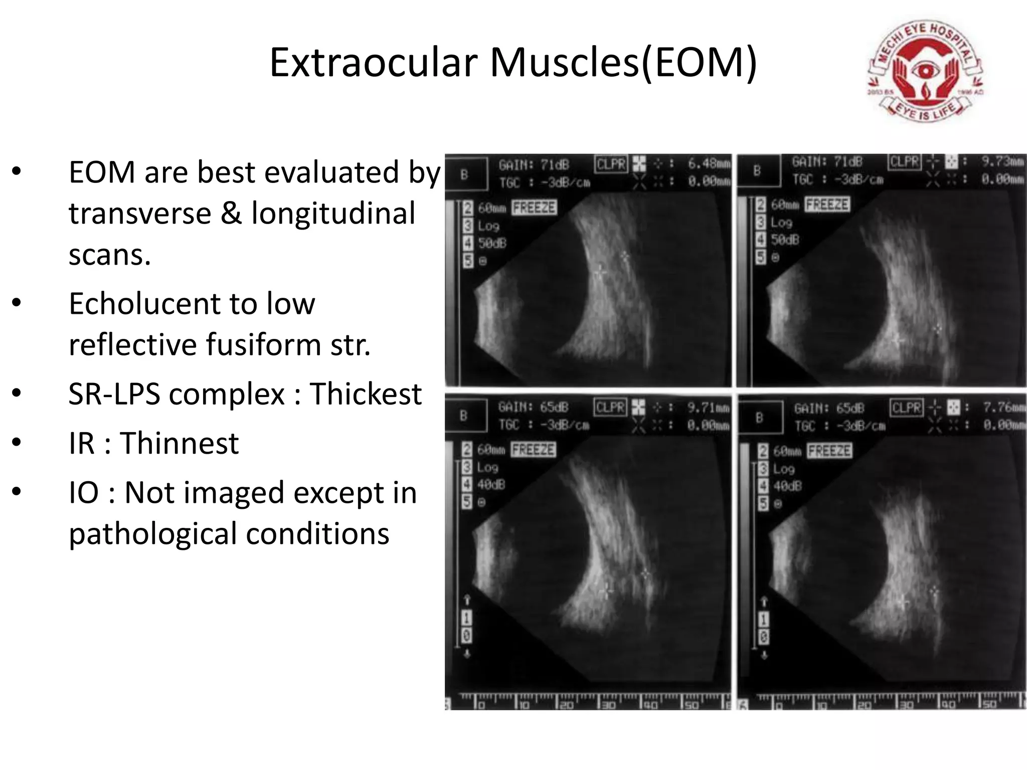 Extraocular Muscles(EOM)
• EOM are best evaluated by
transverse & longitudinal
scans.
• Echolucent to low
reflective fusiform str.
• SR-LPS complex : Thickest
• IR : Thinnest
• IO : Not imaged except in
pathological conditions
 
