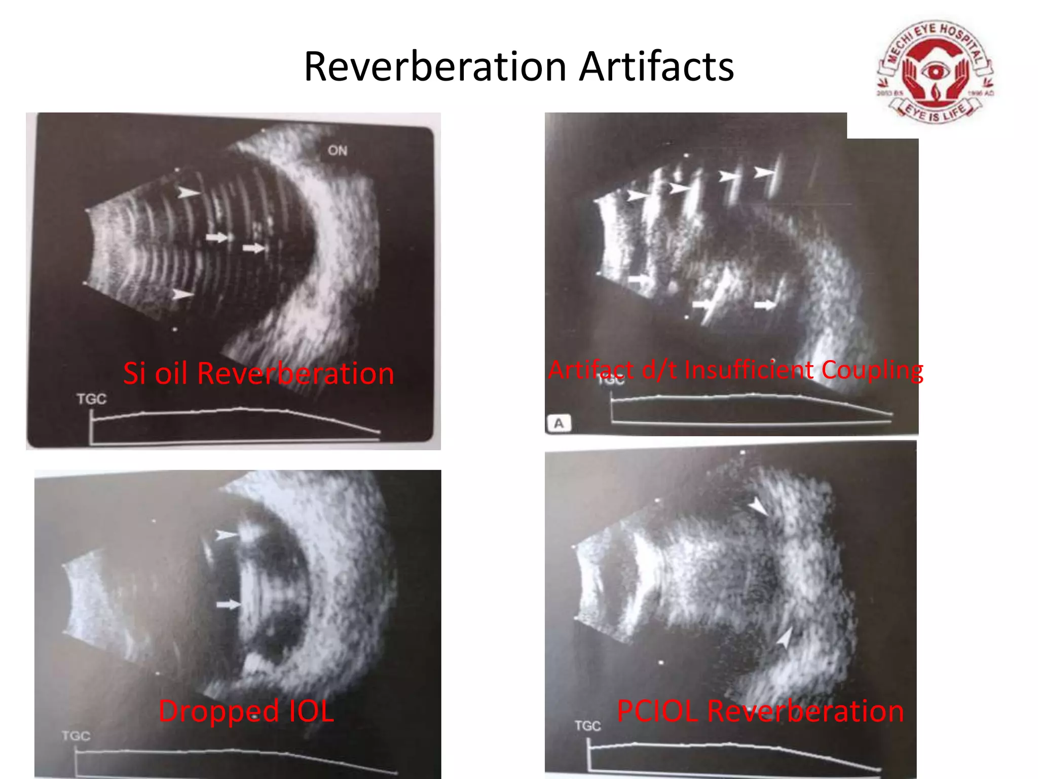 Reverberation Artifacts
Dropped IOL
Si oil Reverberation
PCIOL Reverberation
Artifact d/t Insufficient Coupling
 