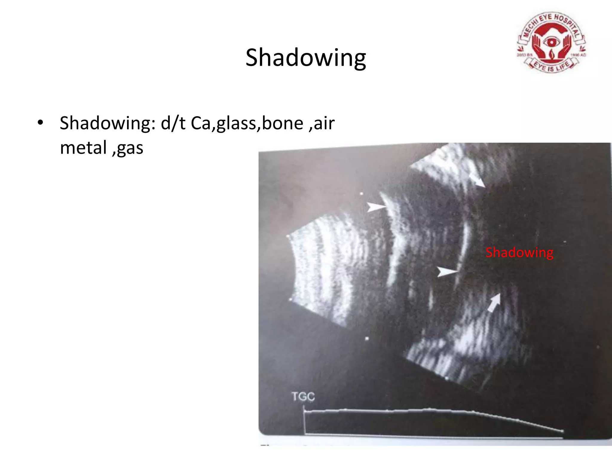 Shadowing
• Shadowing: d/t Ca,glass,bone ,air
metal ,gas
Shadowing
 