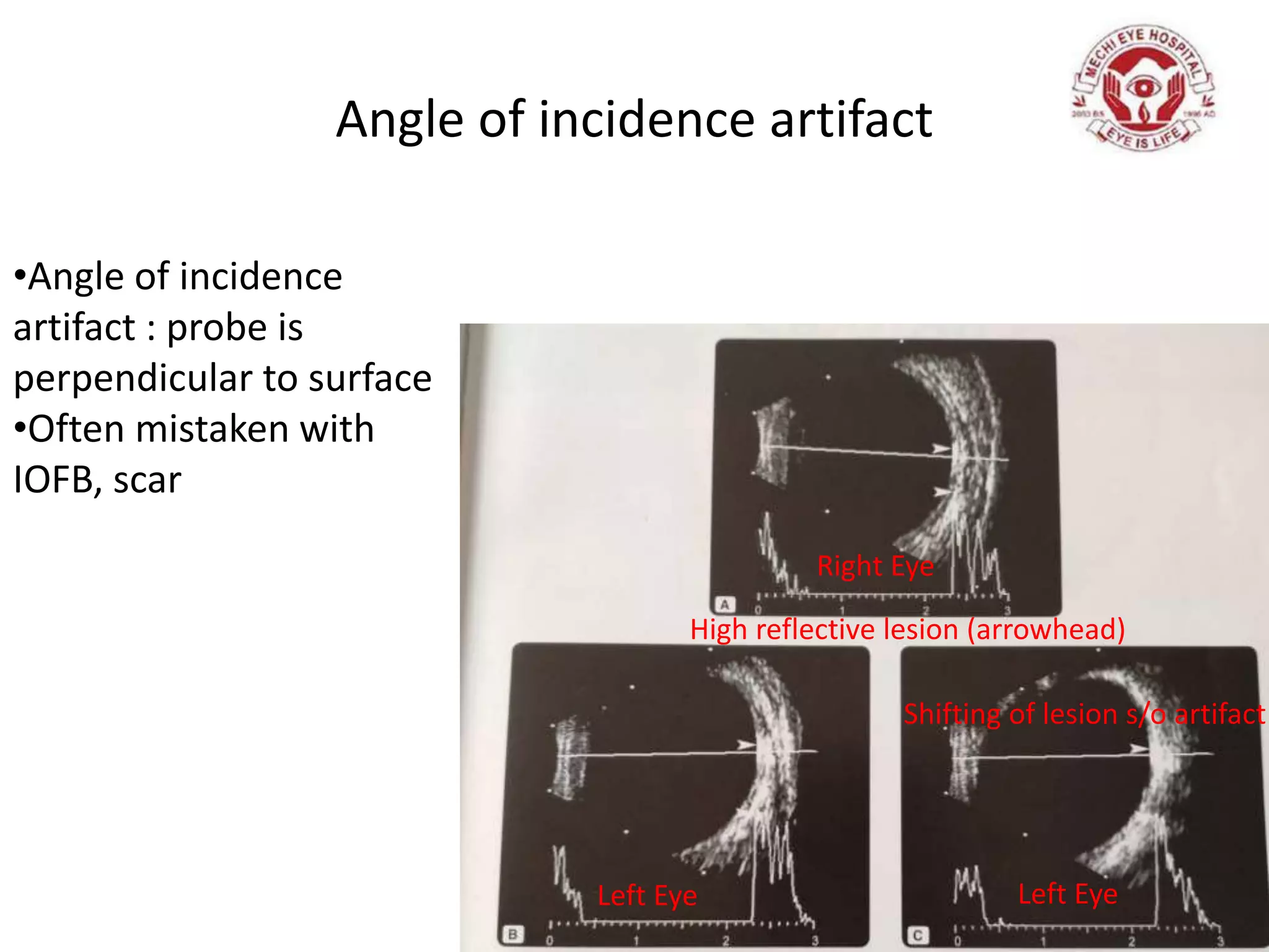 Angle of incidence artifact
Right Eye
Left Eye Left Eye
High reflective lesion (arrowhead)
Shifting of lesion s/o artifact
•Angle of incidence
artifact : probe is
perpendicular to surface
•Often mistaken with
IOFB, scar
 