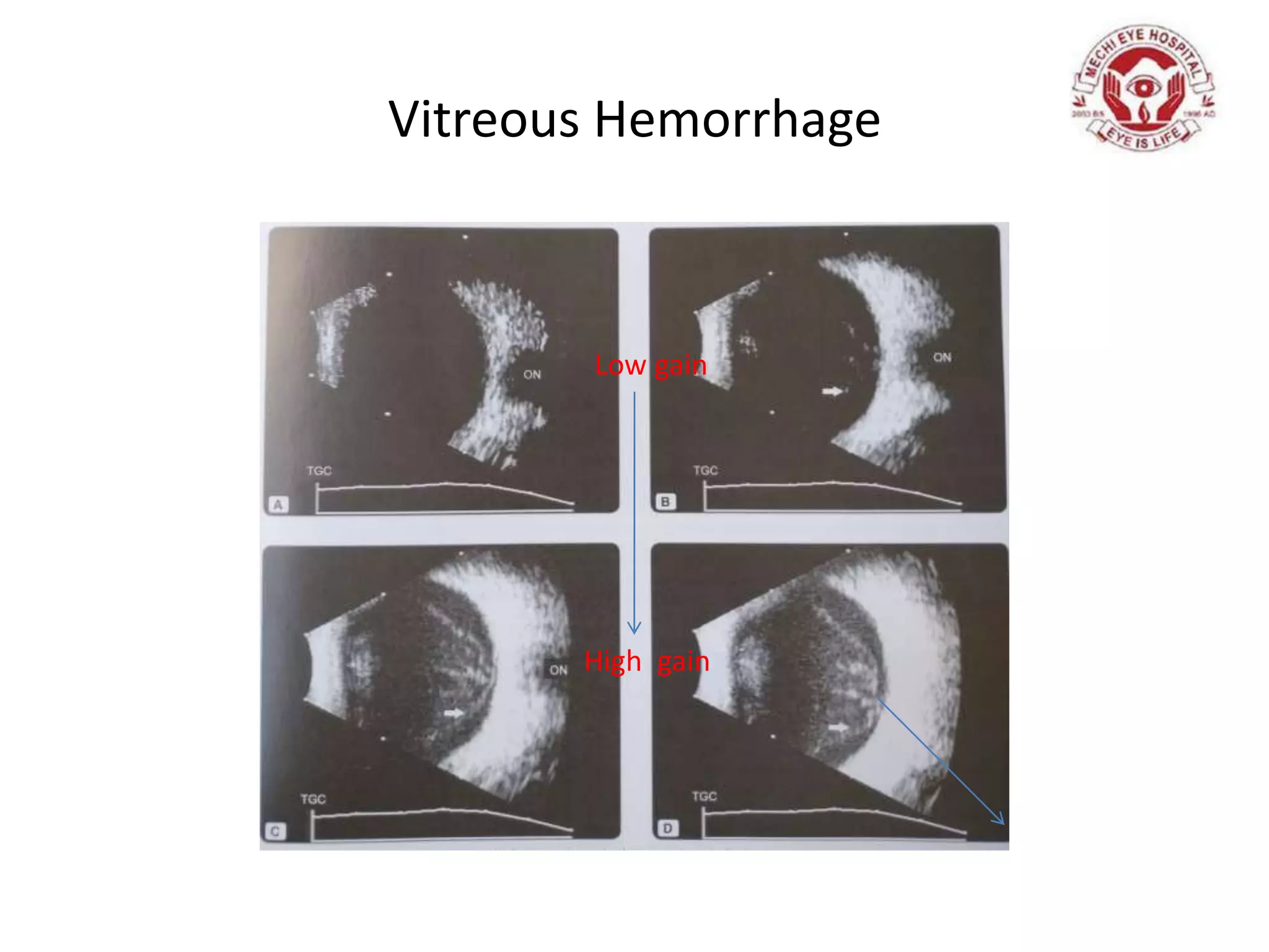 Vitreous Hemorrhage
Low gain
High gain
 