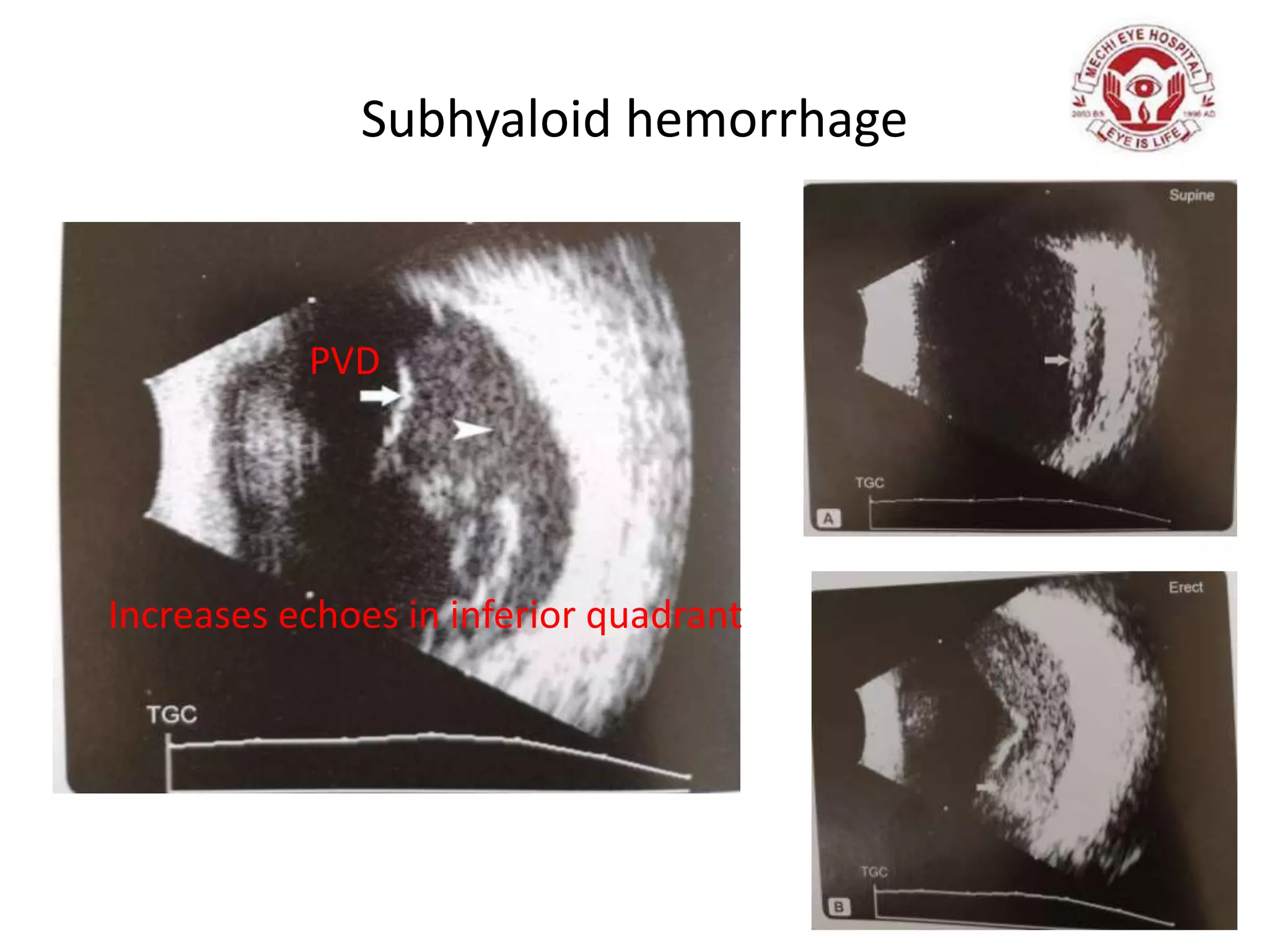Subhyaloid hemorrhage
Increases echoes in inferior quadrant
PVD
 