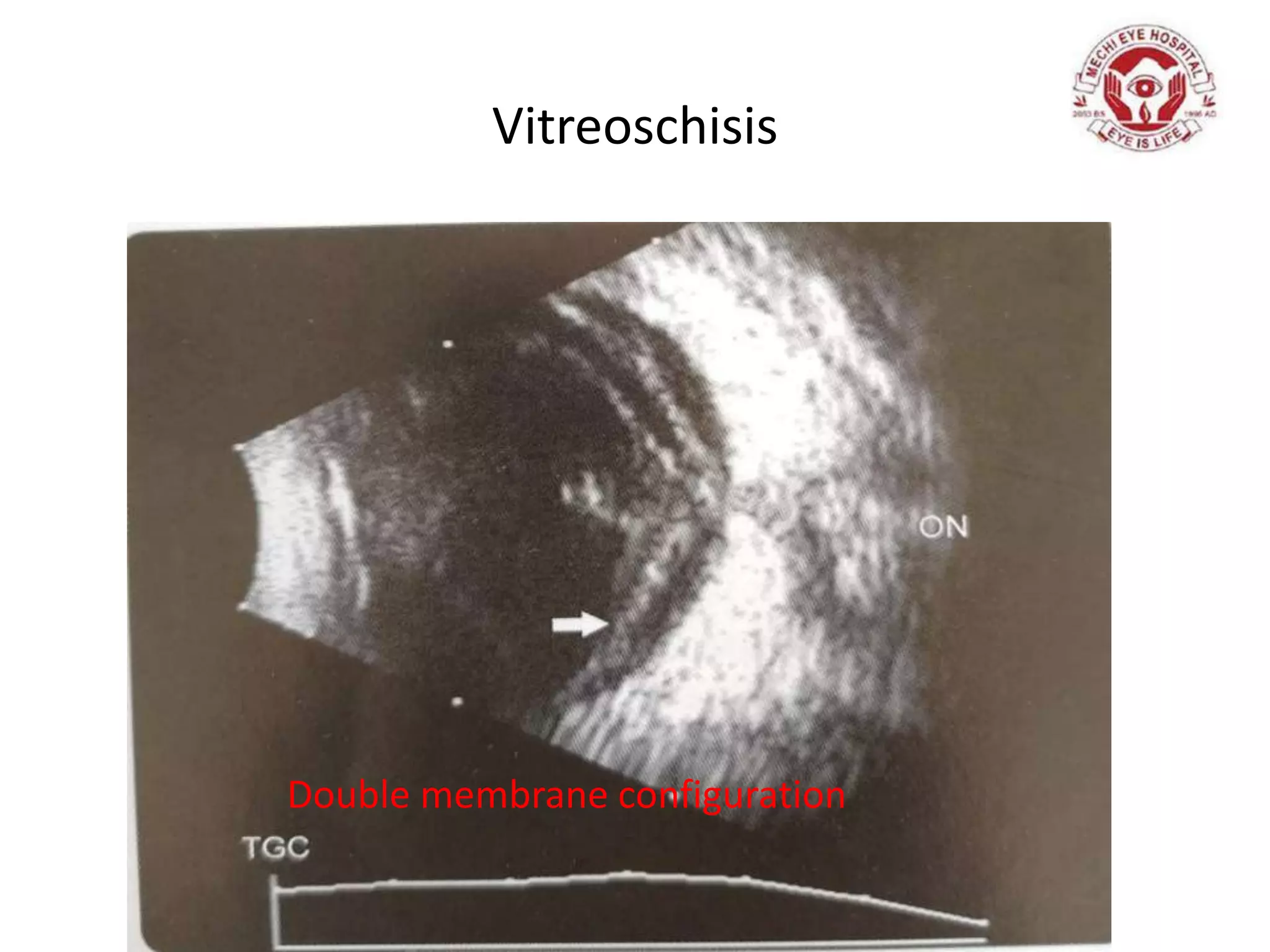 Vitreoschisis
Double membrane configuration
 