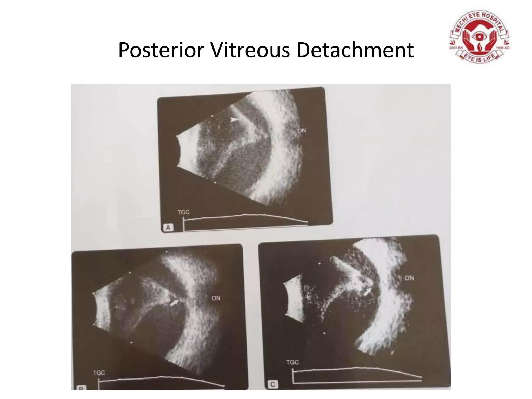 Posterior Vitreous Detachment
 