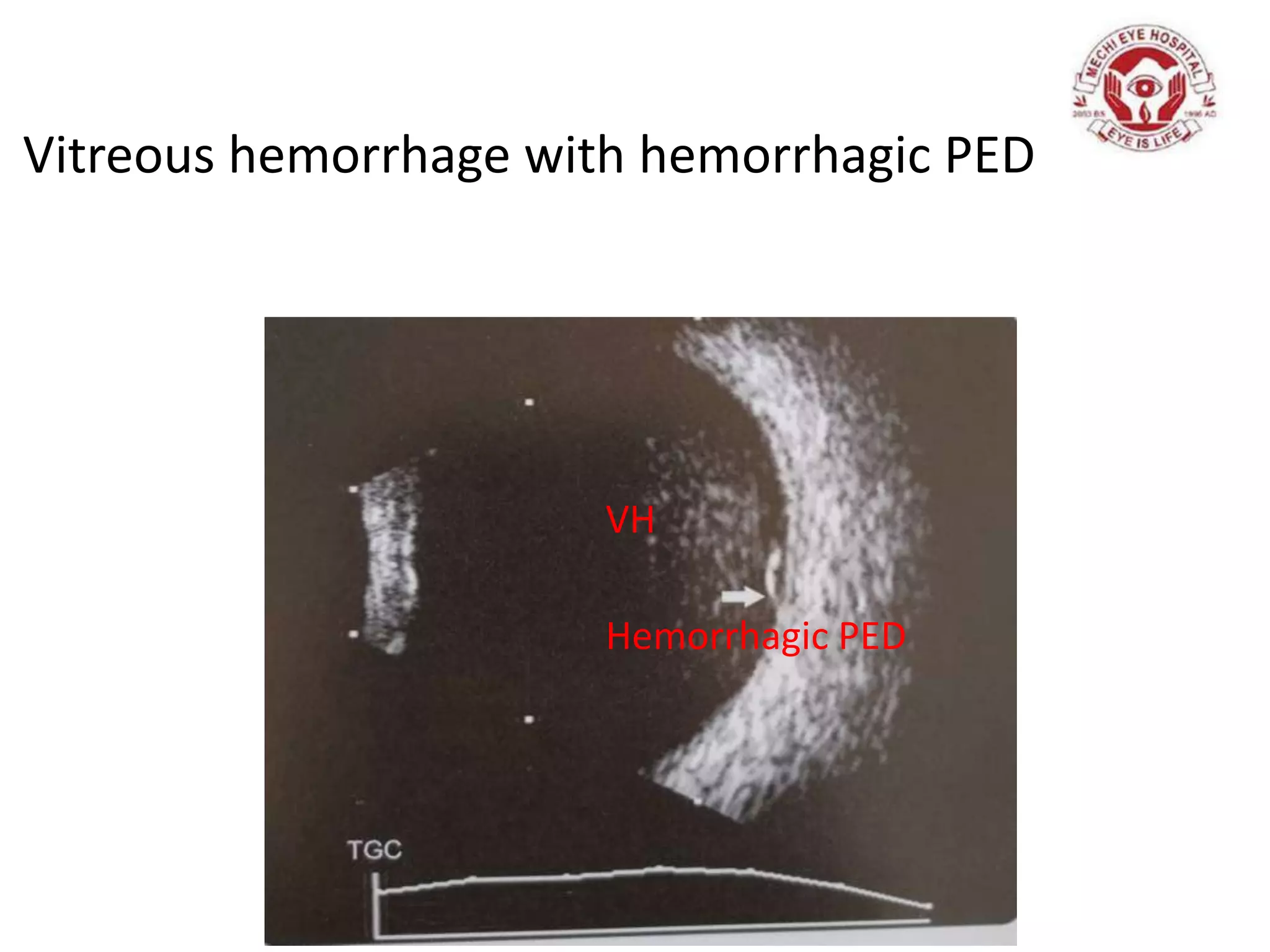Vitreous hemorrhage with hemorrhagic PED
VH
Hemorrhagic PED
 