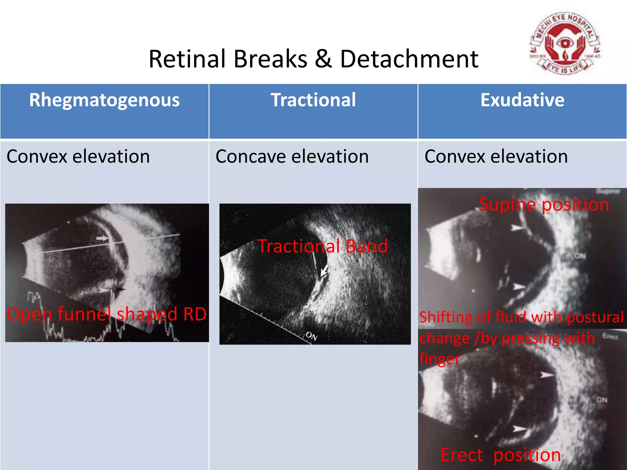 Retinal Breaks & Detachment
Rhegmatogenous Tractional Exudative
Convex elevation Concave elevation Convex elevation
Tractional Band
Shifting of fluid with postural
change /by pressing with
finger
Supine position
Erect position
Open funnel shaped RD
 