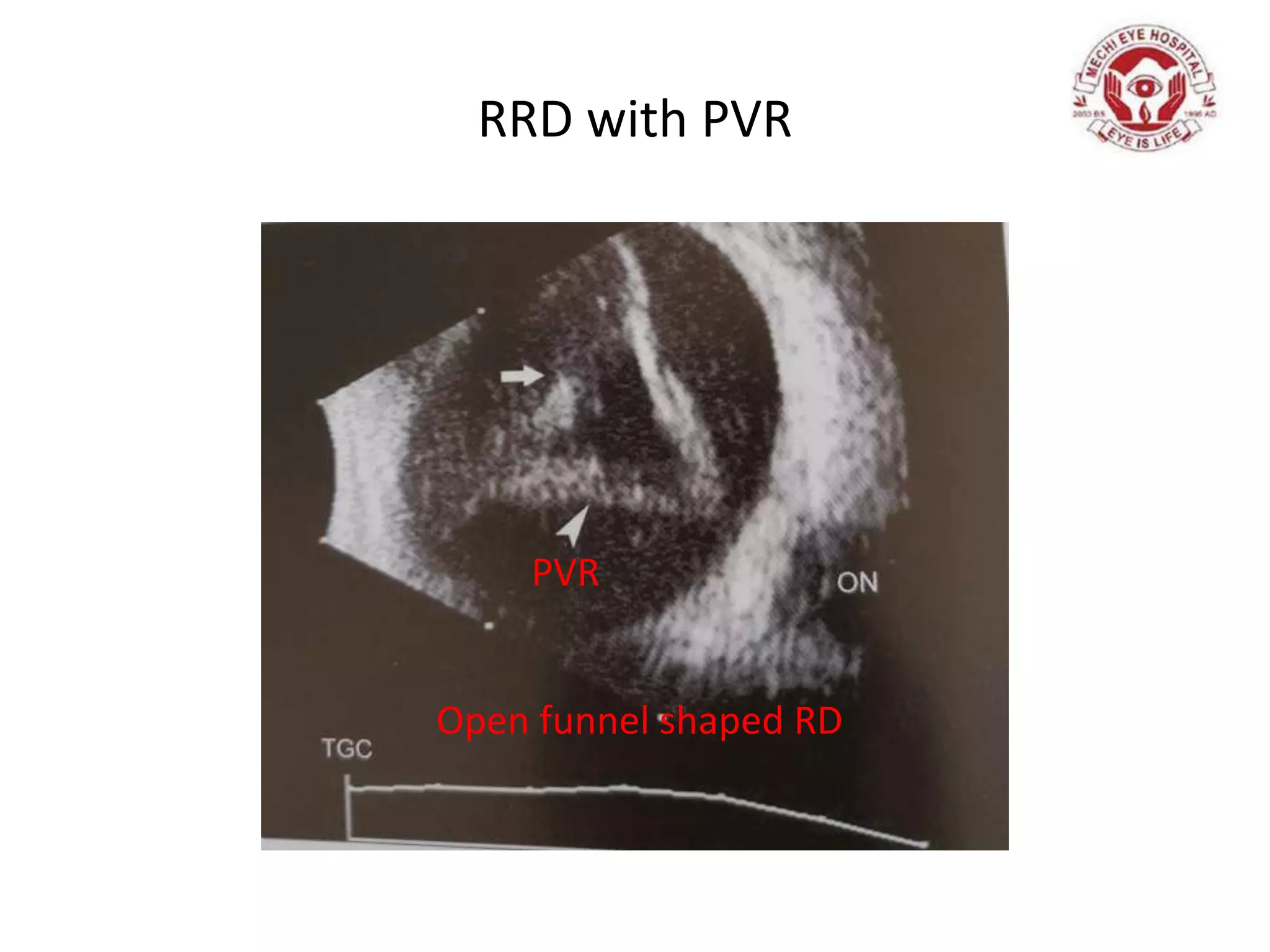 RRD with PVR
PVR
Open funnel shaped RD
 