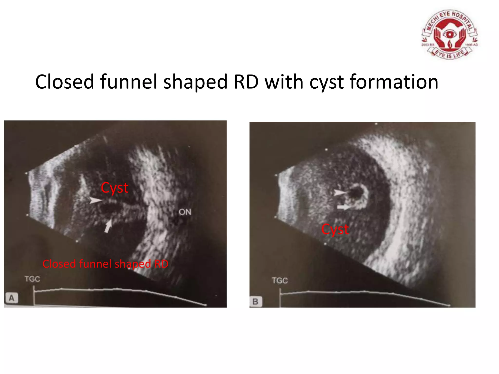 Closed funnel shaped RD with cyst formation
Cyst
Closed funnel shaped RD
Cyst
 