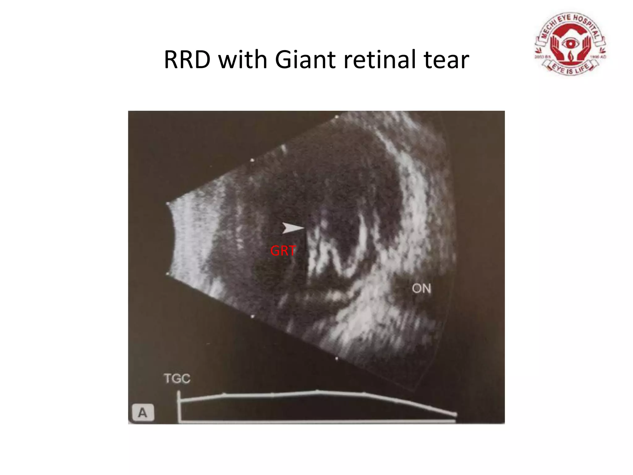 RRD with Giant retinal tear
GRT
 