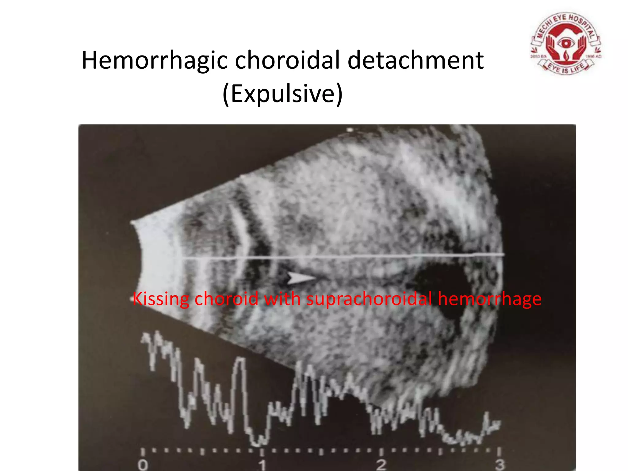 Hemorrhagic choroidal detachment
(Expulsive)
Kissing choroid with suprachoroidal hemorrhage
 