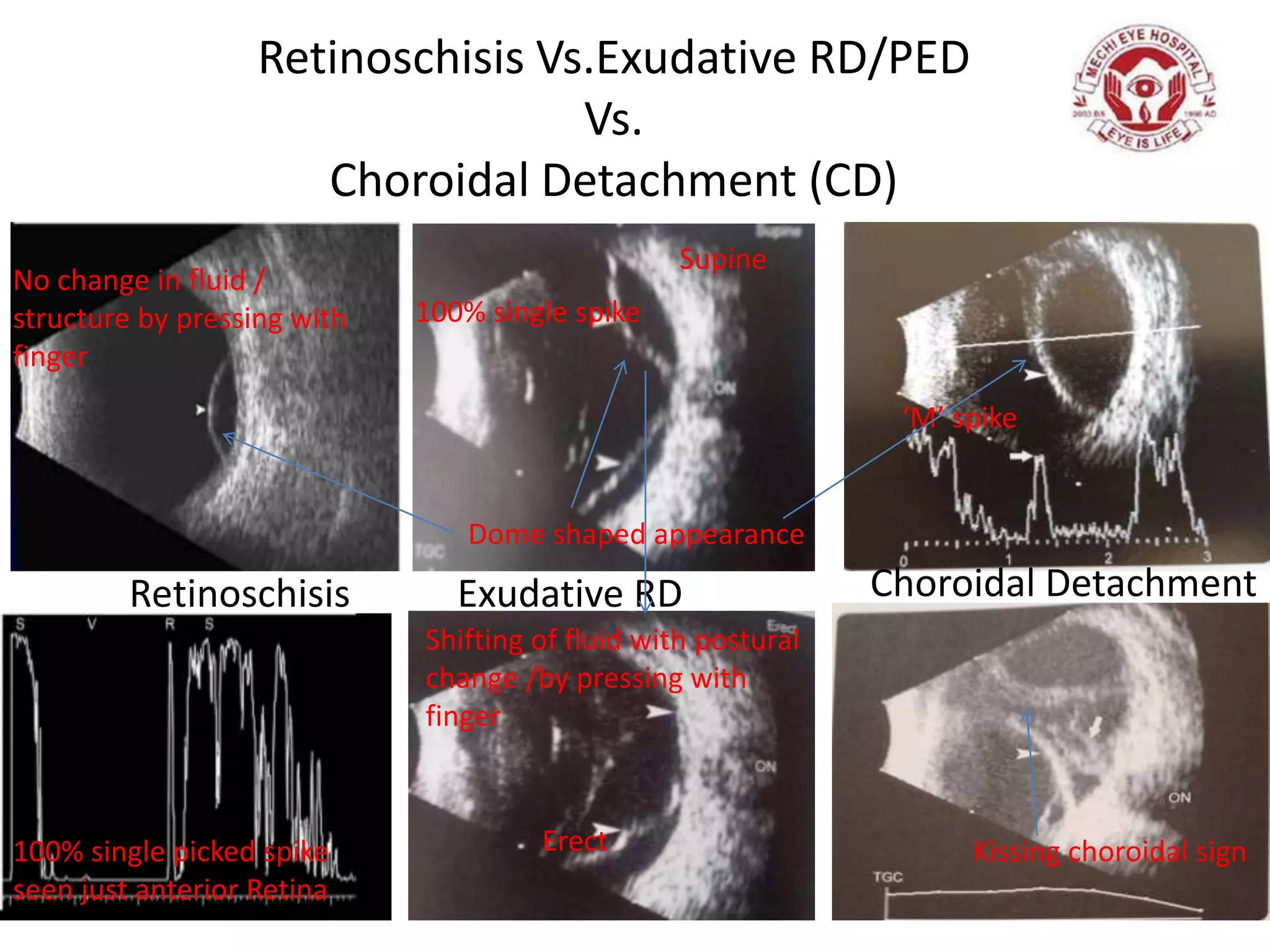 Retinoschisis Vs.Exudative RD/PED
Vs.
Choroidal Detachment (CD)
Retinoschisis Exudative RD Choroidal Detachment
Kissing choroidal sign
‘M’ spike
Dome shaped appearance
Shifting of fluid with postural
change /by pressing with
finger
No change in fluid /
structure by pressing with
finger
Supine
Erect100% single picked spike
seen just anterior Retina
100% single spike
 
