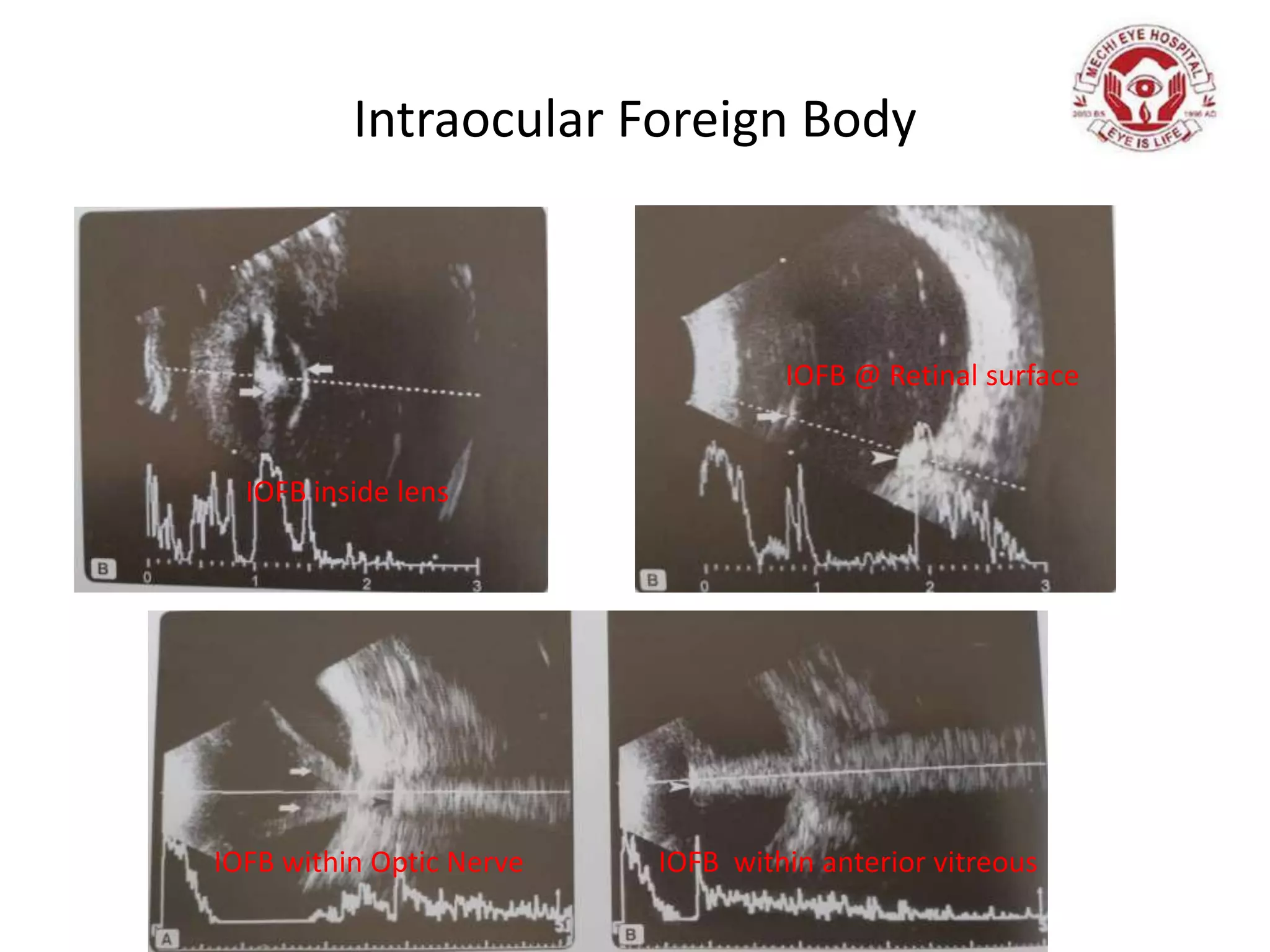 Intraocular Foreign Body
IOFB inside lens
IOFB @ Retinal surface
IOFB within Optic Nerve IOFB within anterior vitreous
 